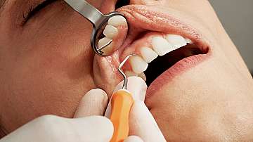 Видове процедури за избелване на зъбите: Постигнете мечтаната усмивка 